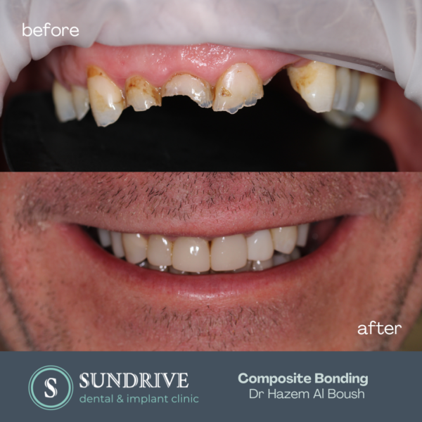 Composite Bonding - Sun Drive Dental and Implant Clinic