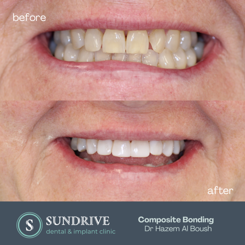 Composite Bonding - Sun Drive Dental and Implant Clinic